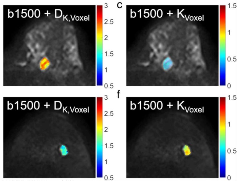 New paper: Differentiating Benign and Malignant Breast Lesions in Diffusion Kurtosis MRI