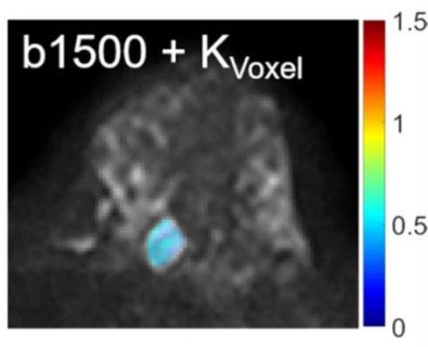 Zum Artikel "Neues Papier: Differentiating Benign and Malignant Breast Lesions in Diffusion Kurtosis MRI"