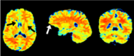 Whole brain CEST MRI 1.2 s per CEST volume