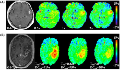 Zum Artikel "Neues Papier: Consensus on clinical APTw CEST MR imaging"