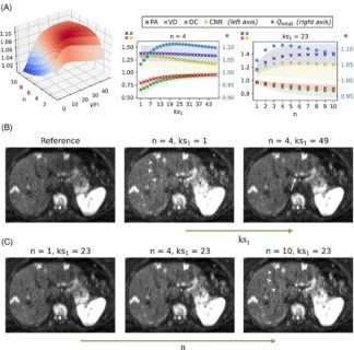 Zum Artikel "Neues Papier: Reduction of the cardiac pulsation artifact and improvement of lesion conspicuity in flow-compensated diffusion images in the liver – A quantitative evaluation of postprocessing algorithms"