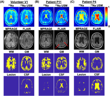 Zum Artikel "Neues Papier: Quantitative 7T sodium magnetic resonance imaging of the human brain using a 32-channel phased-array head coil: Application to patients with secondary progressive multiple sclerosis"
