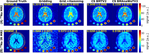Zum Artikel "Neues Papier: Influence of image contrasts and reconstruction methods on the classification of multiple sclerosis-like lesions in simulated sodium magnetic resonance imaging"
