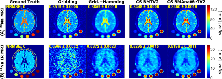 Neues Papier: Influence of image contrasts and reconstruction methods on the classification of multiple sclerosis-like lesions in simulated sodium magnetic resonance imaging