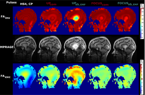 Zum Artikel "New paper: The effects of RF coils and SAR supervision strategies for clinically applicable nonselective parallel-transmit pulses at 7 T"