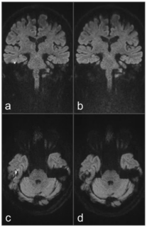 Zum Artikel "Neues Papier: Comparison of Diagnostic Performance and Image Quality between Topup-Corrected and Standard Readout-Segmented Echo-Planar Diffusion-Weighted Imaging for Cholesteatoma Diagnostics"