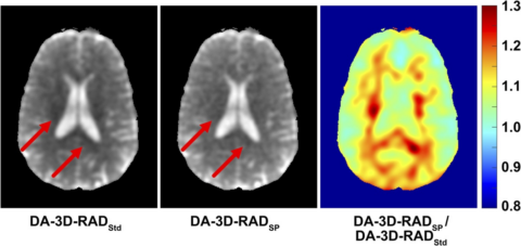 Zum Artikel "New paper: Influence of Residual Quadrupolar Interaction on Quantitative Sodium Brain Magnetic Resonance Imaging of Patients With Multiple Sclerosis"