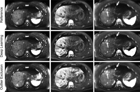 Zum Artikel "New Paper: Feature-guided deep learning reduces signal loss and increases lesion CNR in diffusion-weighted imaging of the liver"