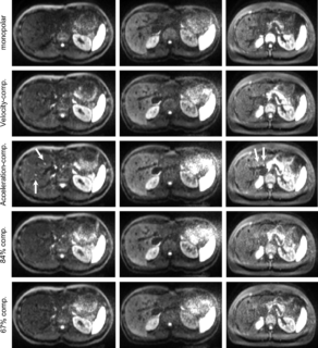 Zum Artikel "Neues Paper: Impact of velocity- and acceleration-compensated encodings on signal dropout and black-blood state in diffusion-weighted magnetic resonance liver imaging at clinical TEs"