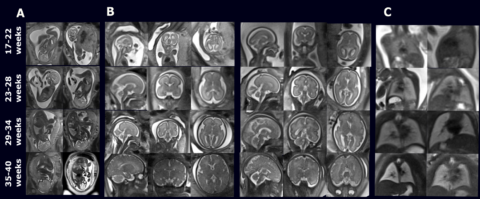 Zum Artikel "New Paper: Reliability and Feasibility of Low-Field-Strength Fetal MRI at 0.55 T during Pregnancy"
