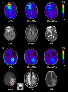 Zum Artikel "New Paper: Fluid suppression in amide proton transfer-weighted (APTw) CEST imaging: New theoretical insights and clinical benefits"