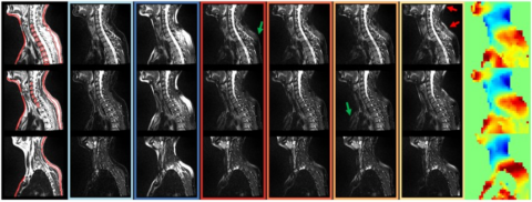 Zum Artikel "New Paper: Fast online spectral-spatial pulse design for subject-specific fat saturation in cervical spine and foot imaging at 1.5 T"