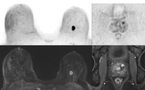 Development and research into shortened MRI procedures for individually adaptive early detection of breast and prostate cancer