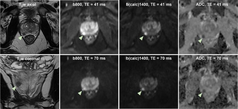 Neues Paper: Pros and Cons of High-Performance Gradient Enabled Short-TE Prostate DWI: A Prospective Study