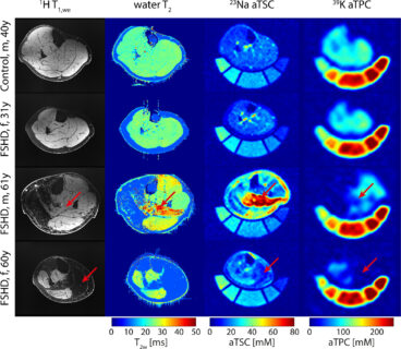 Zum Artikel "New paper: Determination of Tissue Potassium and Sodium Concentrations in Dystrophic Skeletal Muscle Tissue Using Combined Potassium (39K) and Sodium (23Na) MRI at 7T"