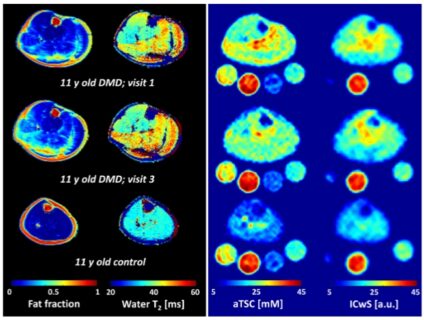 Zum Artikel "New paper: Longitudinal Follow-Up of Patients With DuchenneMuscular Dystrophy Using Quantitative 23Na and 1H MRI"