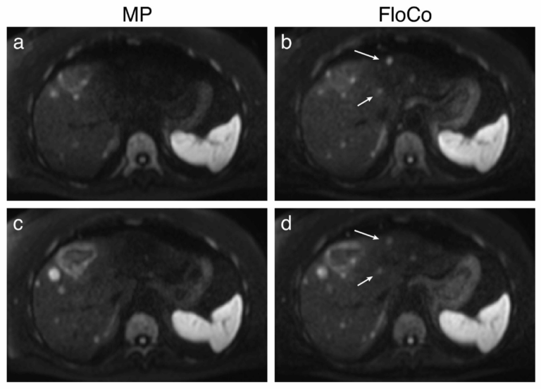 Neues Paper: Flow-Compensated vs. Monopolar Diffusion Encodings: Differences in Lesion Detectability Regarding Size and Position in Liver Diffusion-Weighted MRI