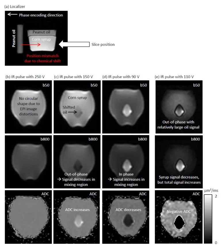 New paper: Overestimation of the Apparent Diffusion Coefficient in Diffusion-Weighted Imaging Due to Residual Fat Signal and Out-of-Phase Conditions