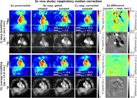 Zum Artikel "Neues Paper: Improved Myocardial Sodium Quantification at 7 T Using Interleaved 23Na/1H pTx MRI With Motion and Anatomy-Based B1 Correction"